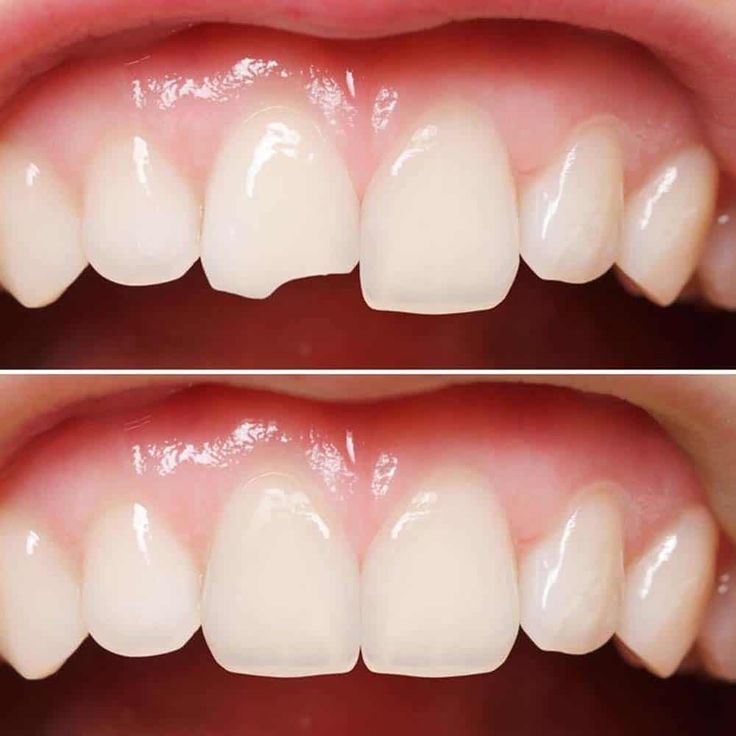 Broken Tooth Repair Dentist Near Me