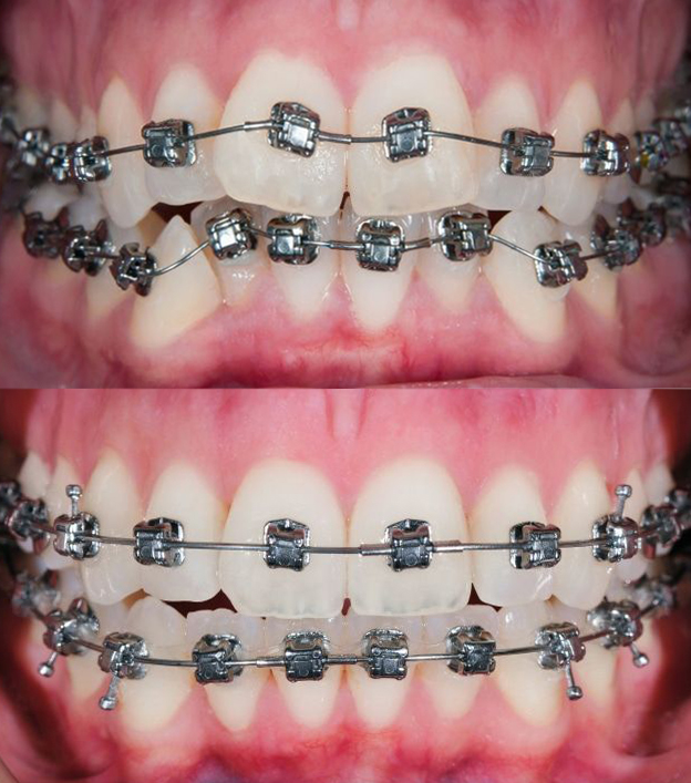 Orthodontic Blog _ Smile Tips & News _ Orthodontic Associates (2)